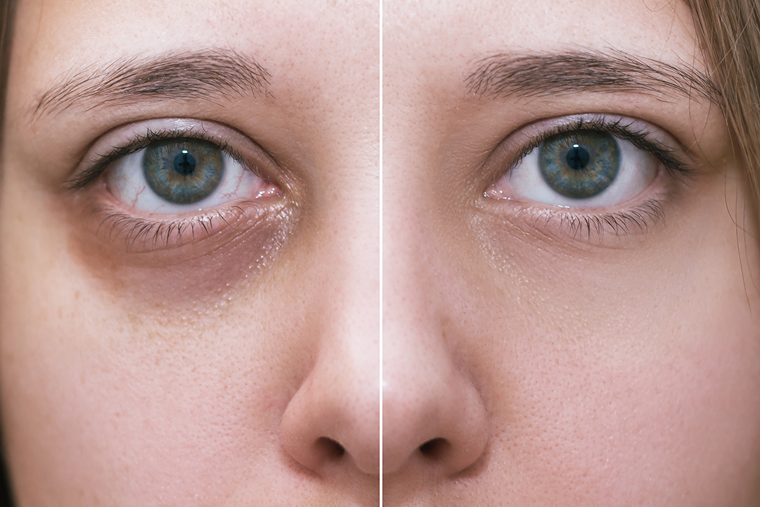 Getting rid of dark circles under your eyes - we'll help you